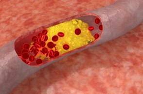 The Great Cholesterol Myth