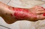  Severe Burns: Best Treatment Options