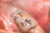 Are Mercury Fillings Really that Bad?