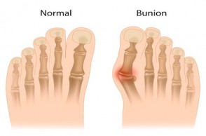 Battling Bunions: What REALLY Happens During Surgery