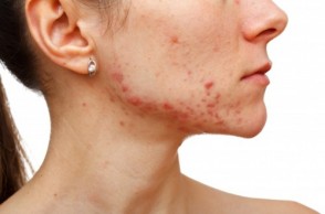 Accutane: The Miracle Acne Drug? 