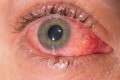 Conjunctivitis: What Is Pink Eye?