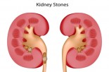 Painful Truth About Kidney Stones 