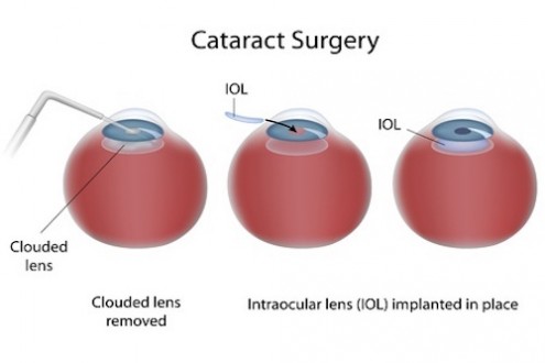 Everything You Need to Know About Cataract Surgery