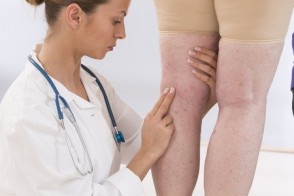 Varicose Veins: Health Impact & Treatment Options