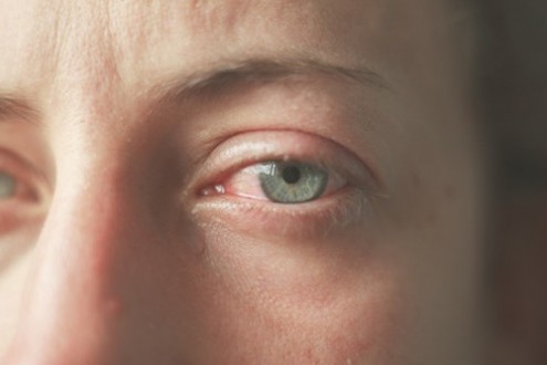 Get the Scoop on Red, Dry, Itchy Eyes