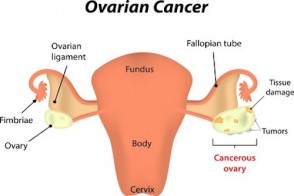 Ovarian Cancer: What You Need to Know