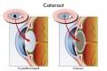 Dear Doctor: What Is a Cataract?